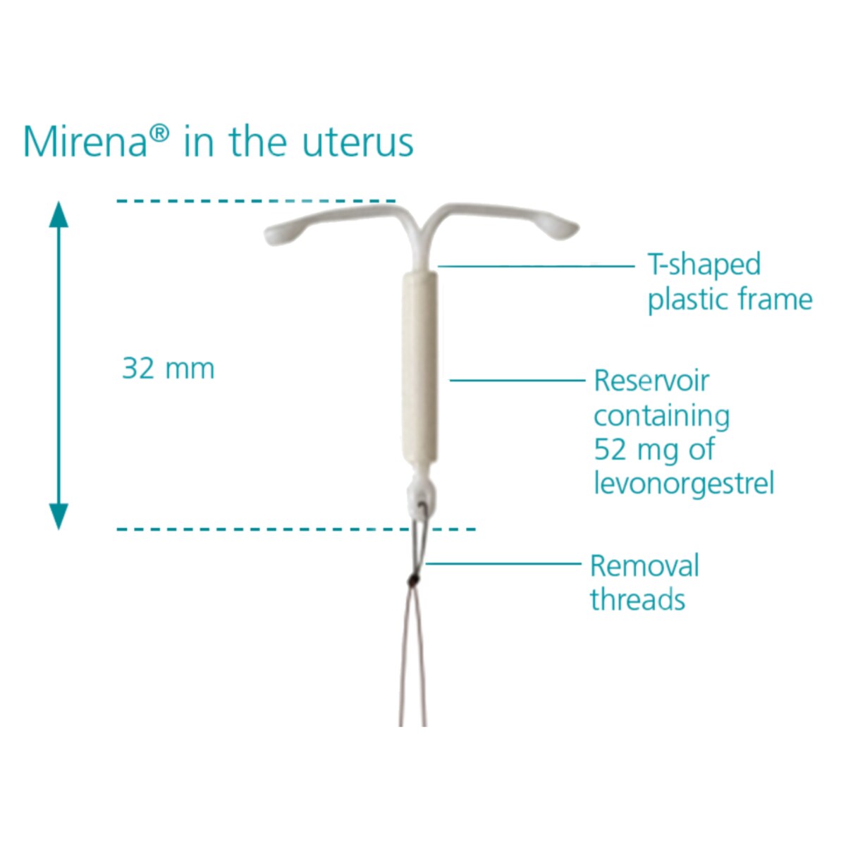 Mirena (52mg levonorgestrel) Intrauterine System