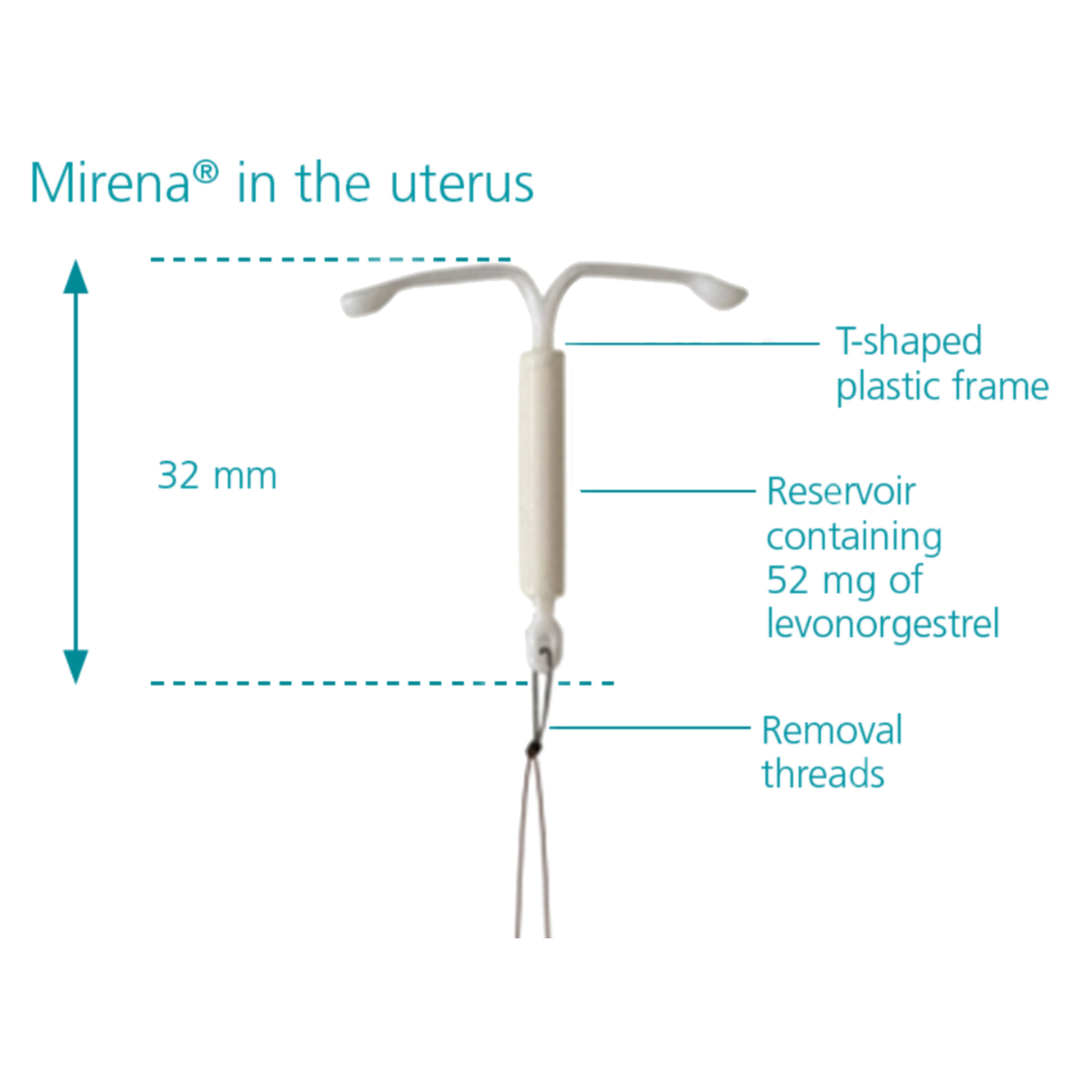 Mirena (52mg levonorgestrel) Intrauterine System