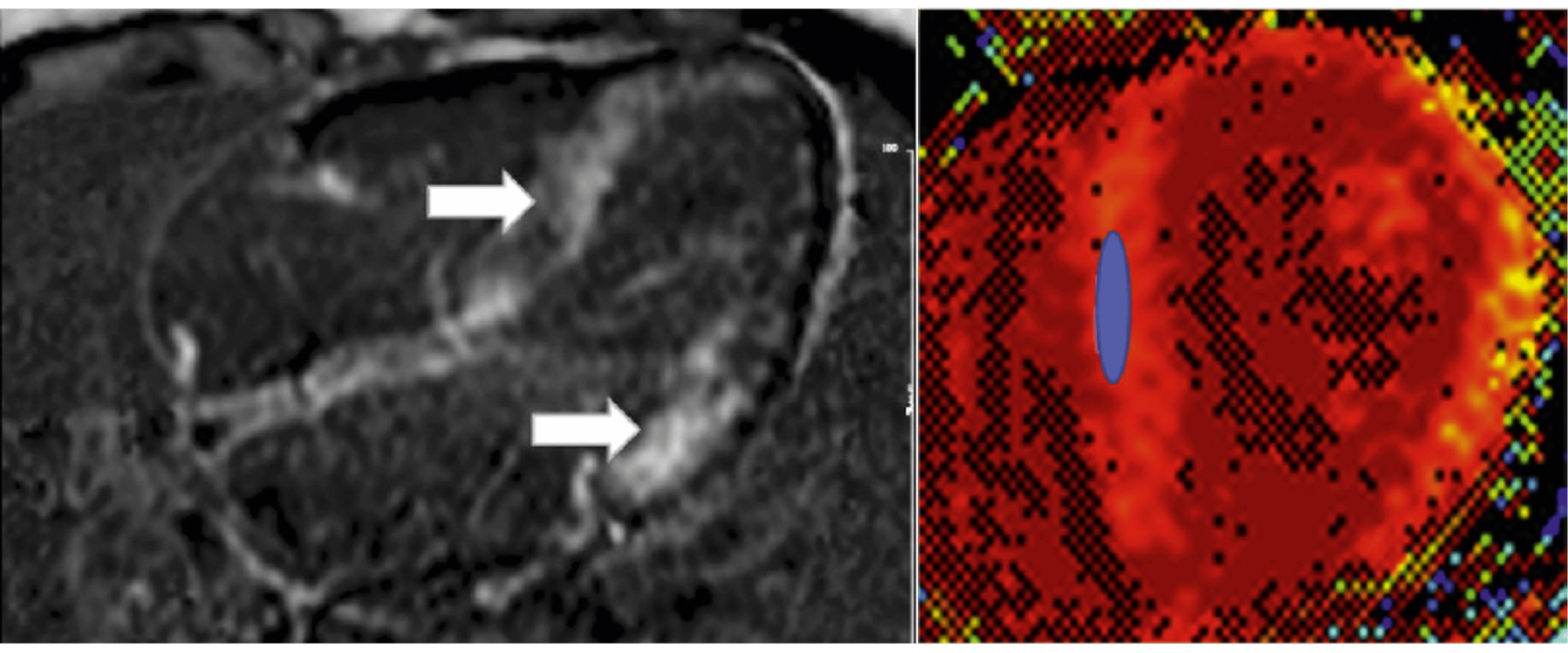 Changes in cardiac magnetic resonance (CMR) in ATTR-CM Changes in cardiac magnetic resonance (CMR) in ATTR-CM