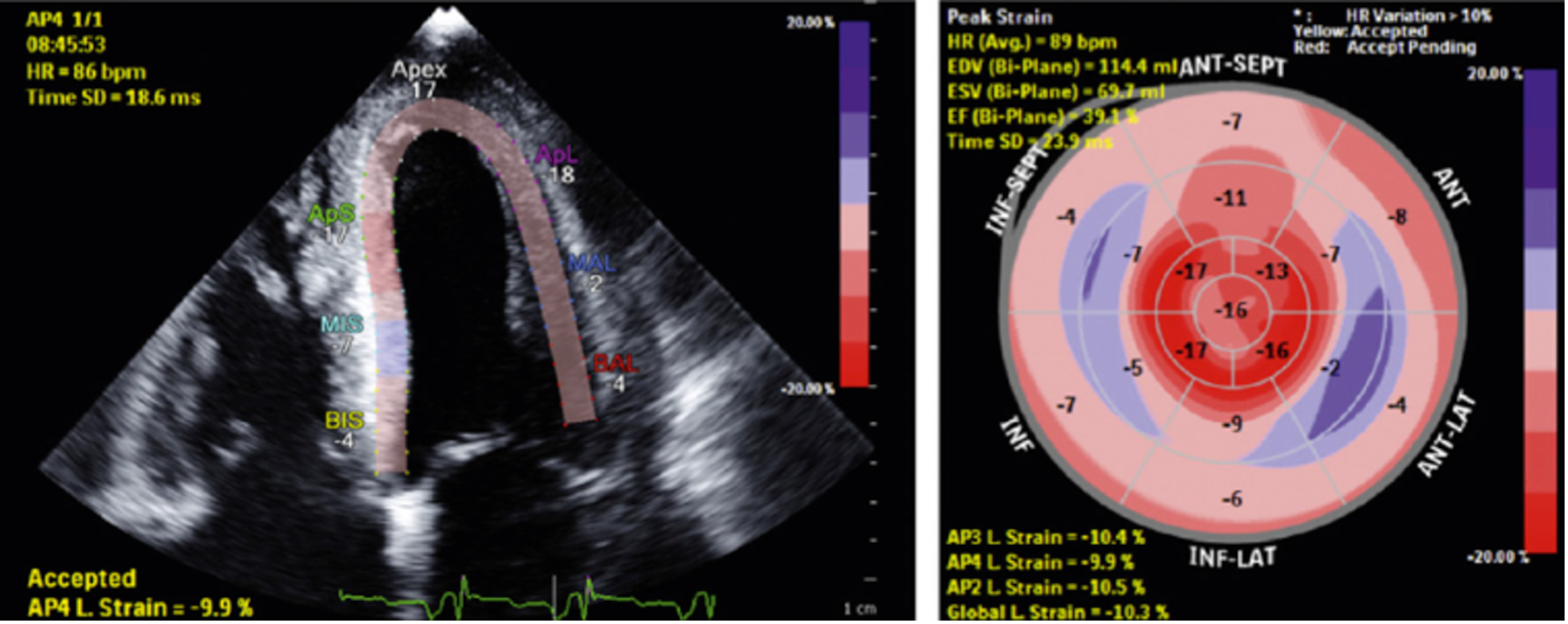 Echocardiogram abnormalities in ATTR-CM Echocardiogram abnormalities in ATTR-CM