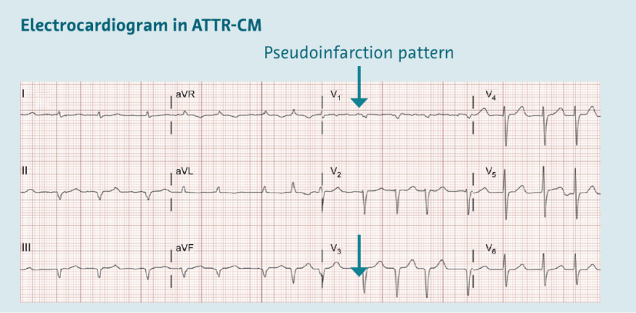 Electrocardiogram of a patient with ATTRwt-CM Electrocardiogram of a patient with ATTRwt-CM
